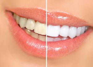 Преимущества лазерного отбеливания зубов