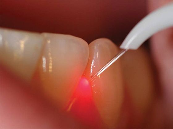 Лазерная стоматология