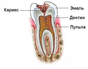 Кариес зубов