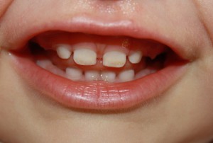 Гипоплазия эмали зубов у детей