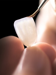 Прямые и керамические виниры в стоматологии