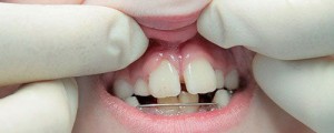 Травмирование зубов у детей