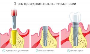 Имплантация зубов под ключ