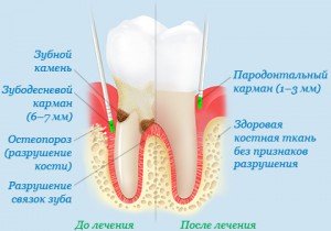 Пародонтит: причины, лечение и симптомы